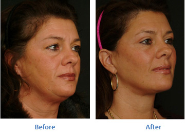Get Back Your Radiance and Youth With A Face-lift Surgery