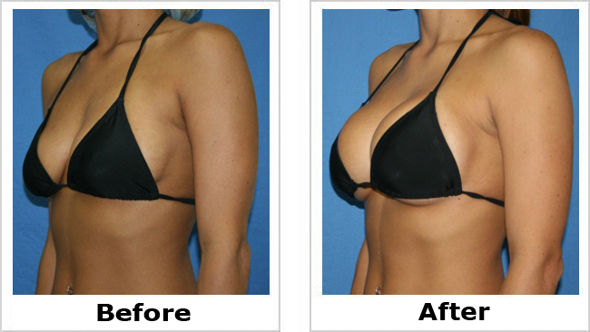 breast-augmentation-NJ
