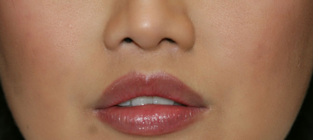 Lip Lift - A Brief Guide Explaining Everything About The Procedure