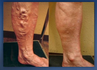 What Are The Symptoms Of Varicose Veins And How To Get Rid From It?
