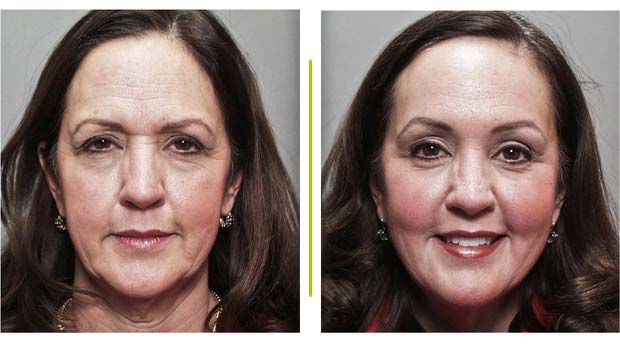 Procedures and Complications Linked With Endoscopic Brow Lift Service