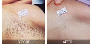 3 Tips On How To Maximize Your Laser Hair Removal Experience