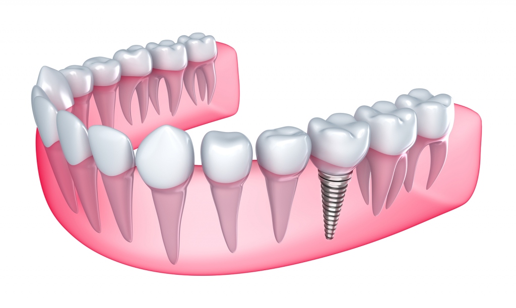 Types Of Tooth Replacement and Benefits