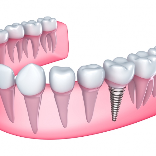 Types Of Tooth Replacement and Benefits