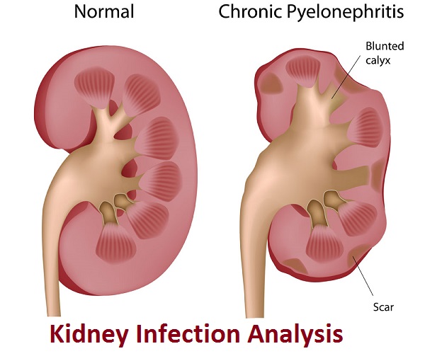 What Is Kidney Infection And How To Cure?