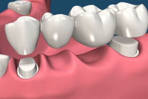 How Does The Dental Bridges Performed by Dentists