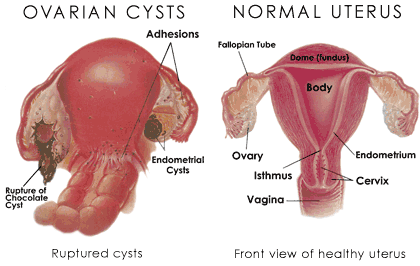 Ovarian Cysts – Causes, Symptoms &amp; Diagnosis