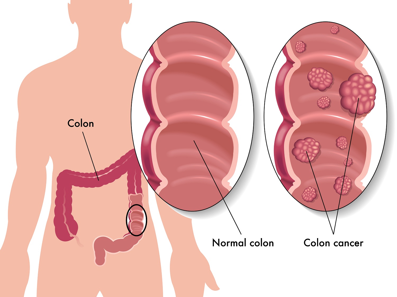 5 Ways To Reduce The Risk Of Colon Cancer