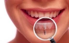 An Overview Of The Dental Implants and How They Are Used