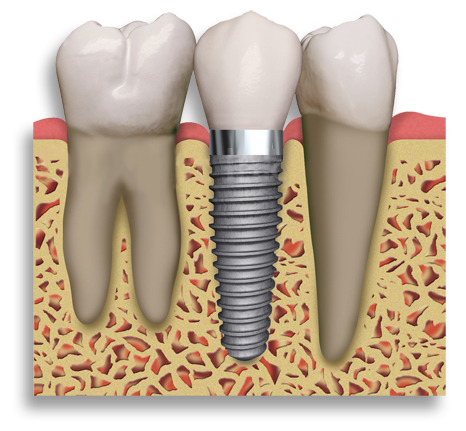 The Impact Of Dental Implants In Mouth Beautification