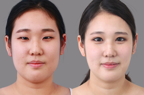 Things To Inquire About Lower Eyelid Surgery