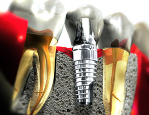 A Perfect Guide Know Everything About Your Root Canal Treatment