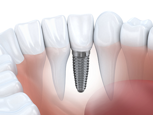 How Dental Implants Can Be Beneficial To You