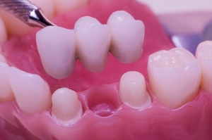 3 Dental Bridge Problems You Should Avoid