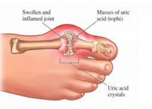 What You Should Know About Gout Treatment With Ayurvedic Medicine