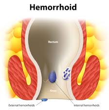 Important Facts About Hemorrhoid