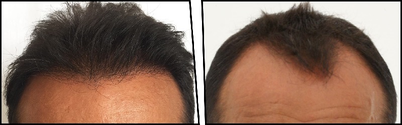 FUE Hair Transplant: What You Need to Know