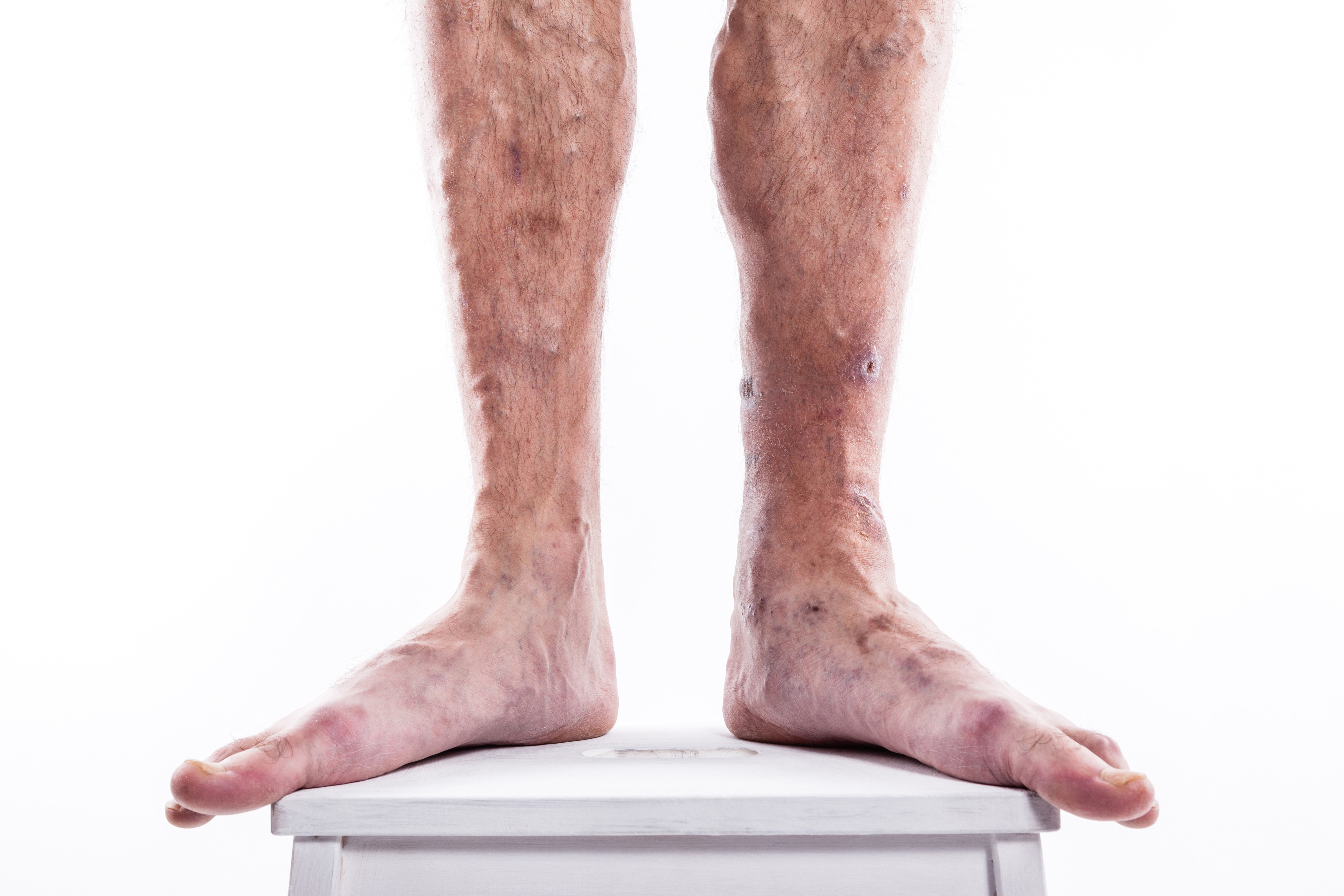 How Can I Treat My Varicose Veins?